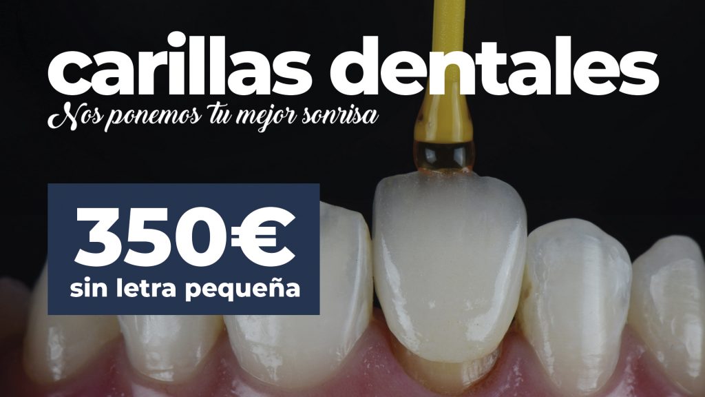 Carillas Dentales Baratas en Madrid
